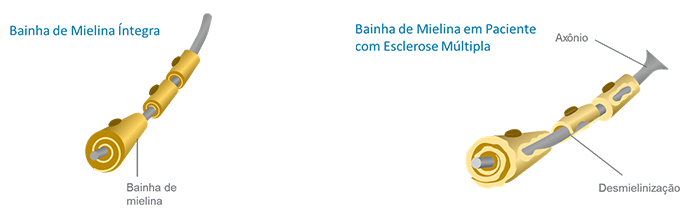 Ilustração que representa a diferença entre a bainha de mielina saudável e a bainha de mielina do paciente com esclerose múltipla